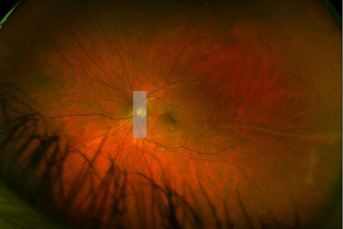 full fundus optos image